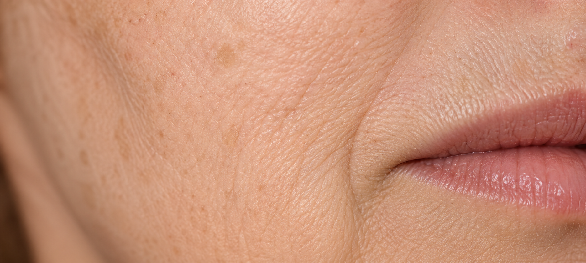 laser-prima before-laser
