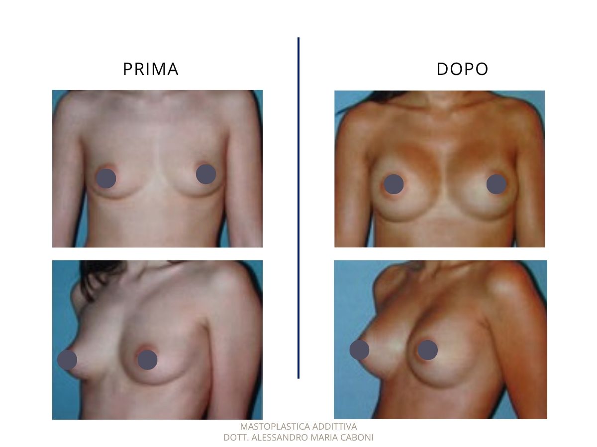 Mastoplastica additiva