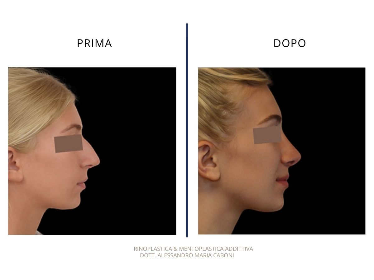 Rinoplastica & Mentoplastica addittiva