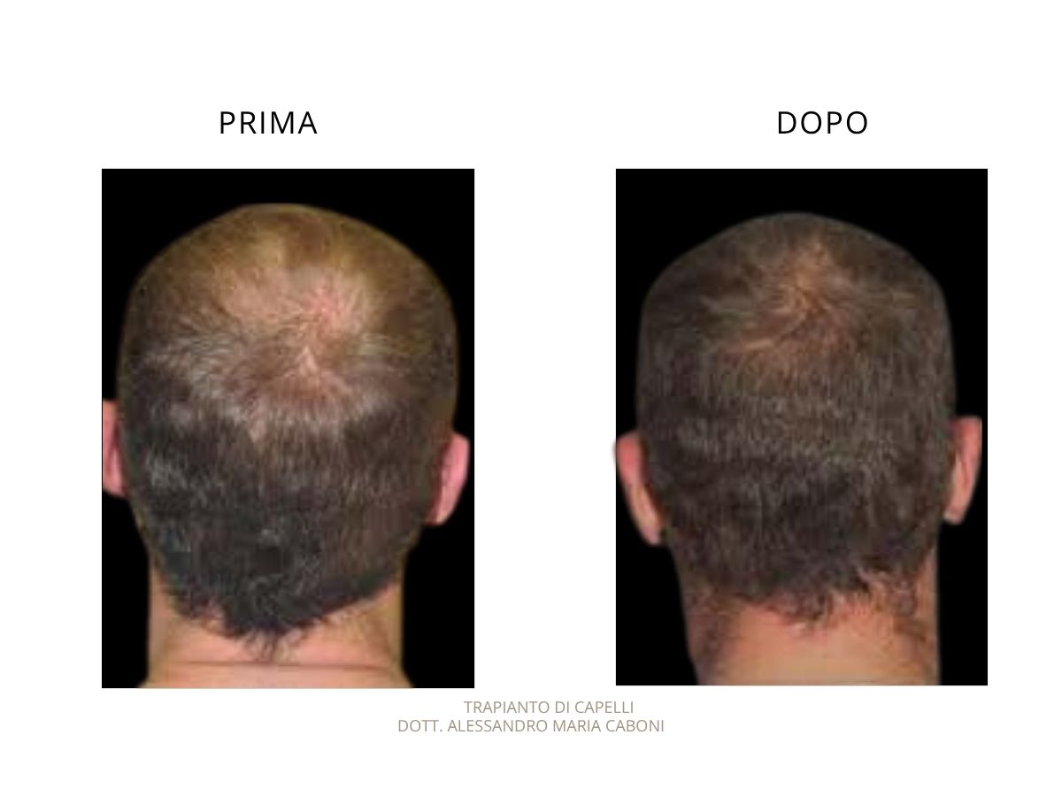 Trapianto di capelli