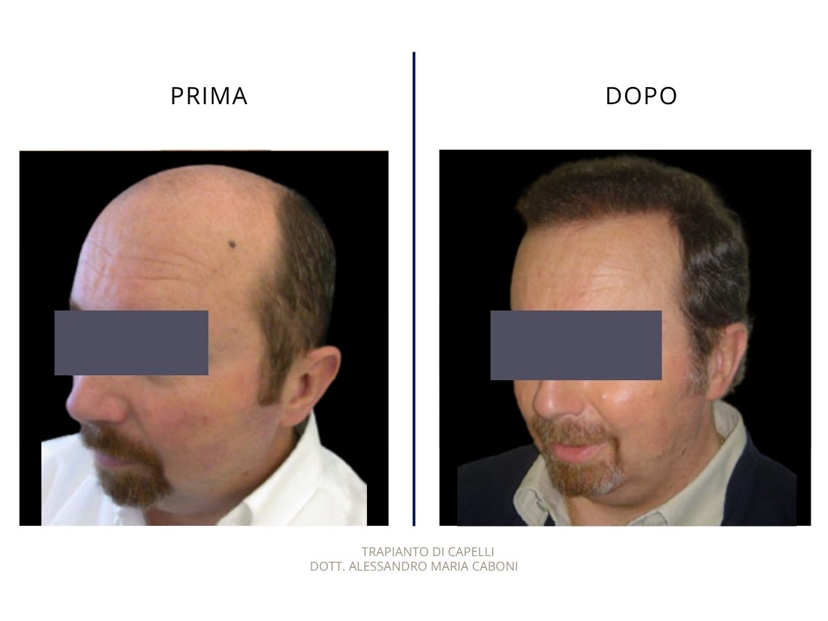Trapianto di capelli