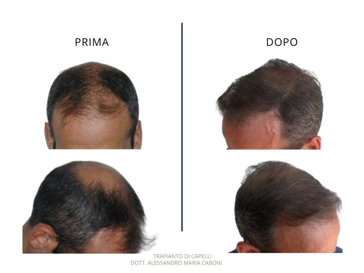 Trapianto di capelli