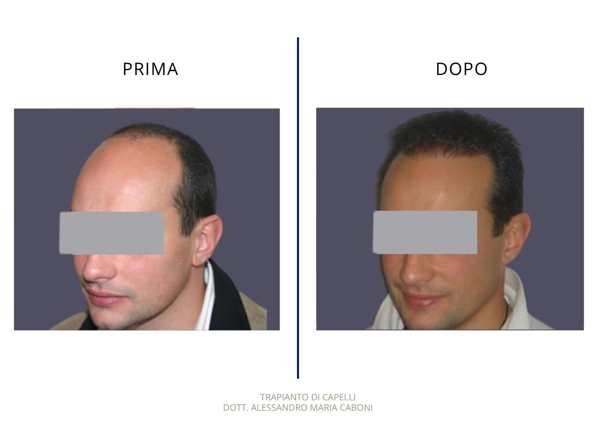 Trapianto di capelli
