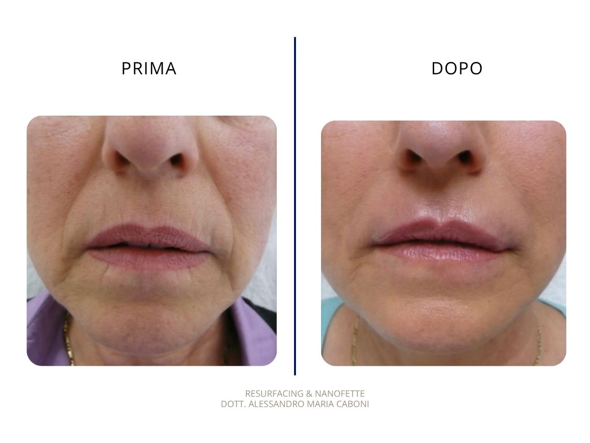 Resurfacing & Nanofette
