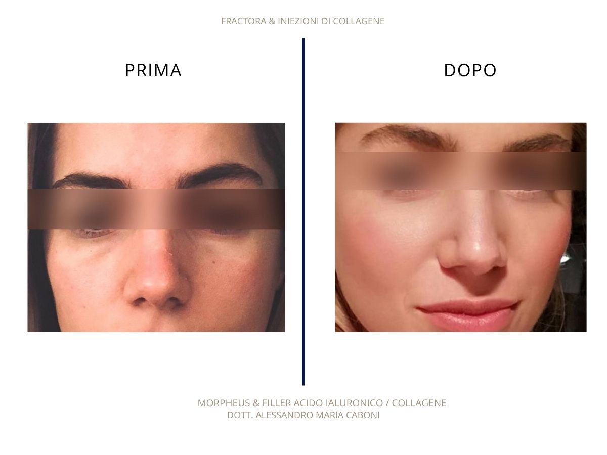 Morpheus, Filler Acido Ialuronico, Collagene