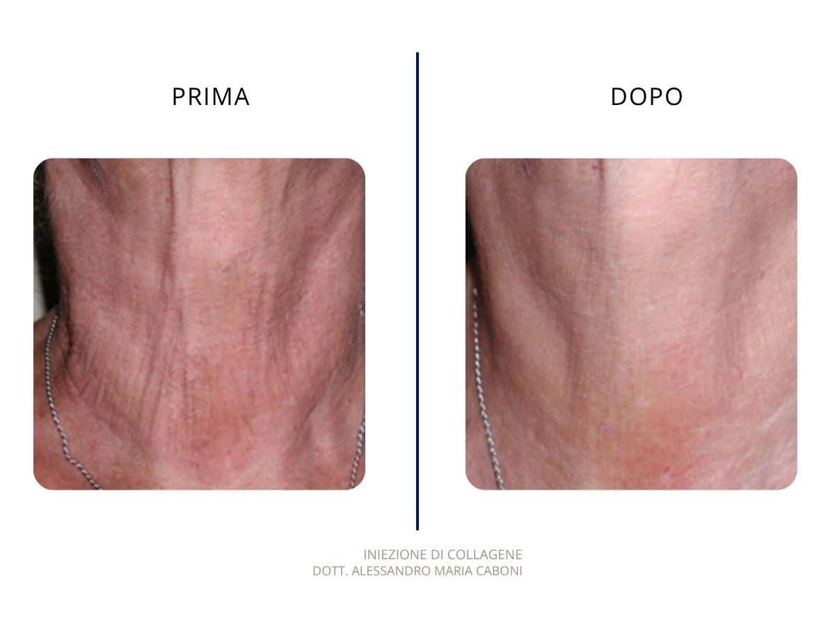 Collagene Iniezione