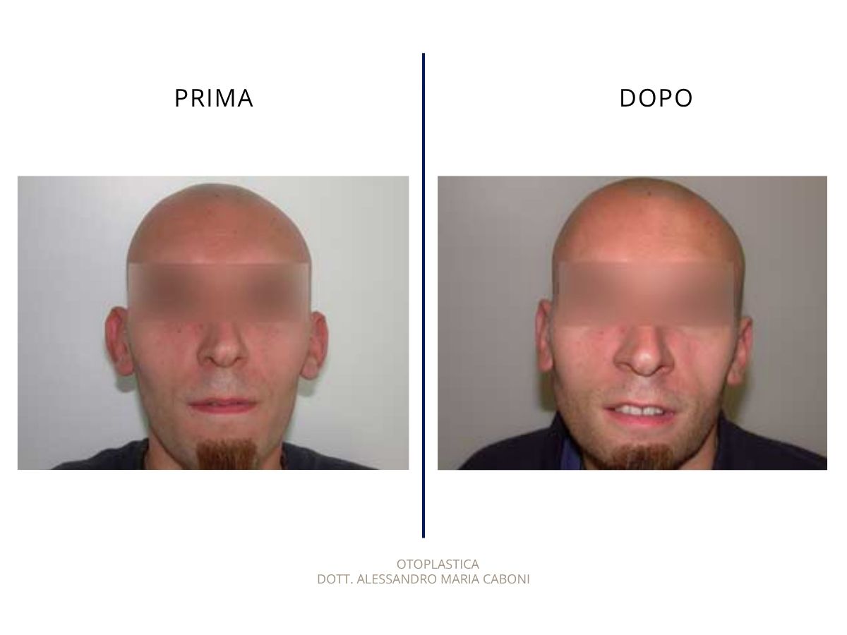 Otoplastica