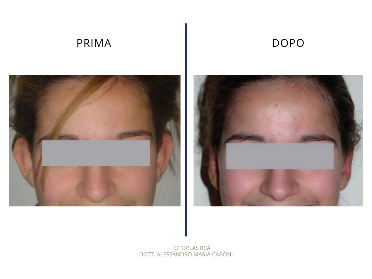 Otoplastica