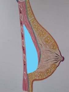 Protesi mammaria sottomuscolare