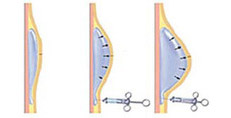 Aumento Seno Cellule Staminali_1