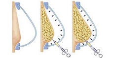 Aumento Seno Cellule Staminali_2